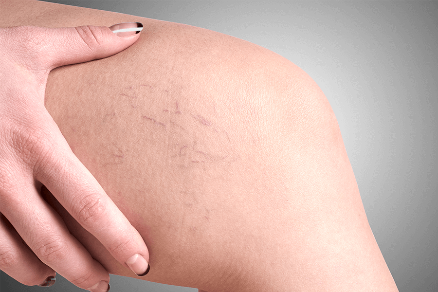 Can I Fix the Spider Veins on My Face? - The New York Times