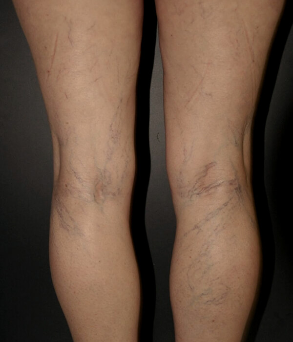 before sclerotherapy treatment