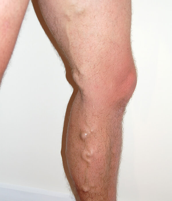 leg with bulging varicose vein before sclerotherapy treatments