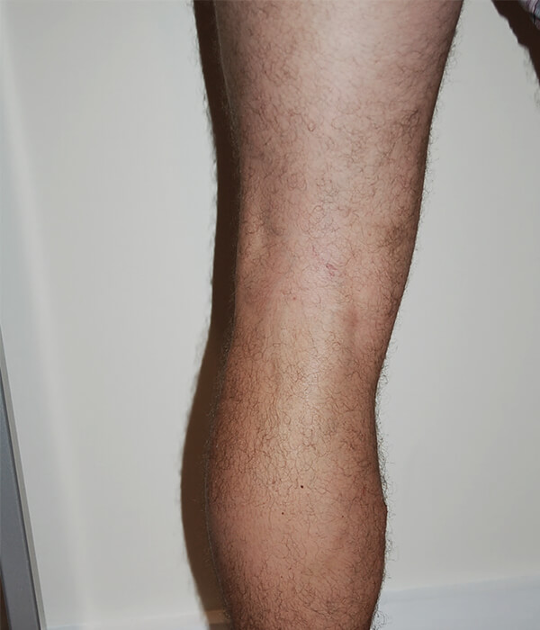 Close-up of legs with varicose veins