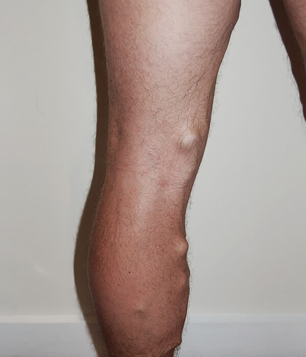 Treatment results of varicose veins