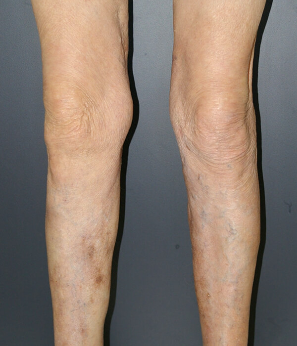 legs after severe varicose veins are treated