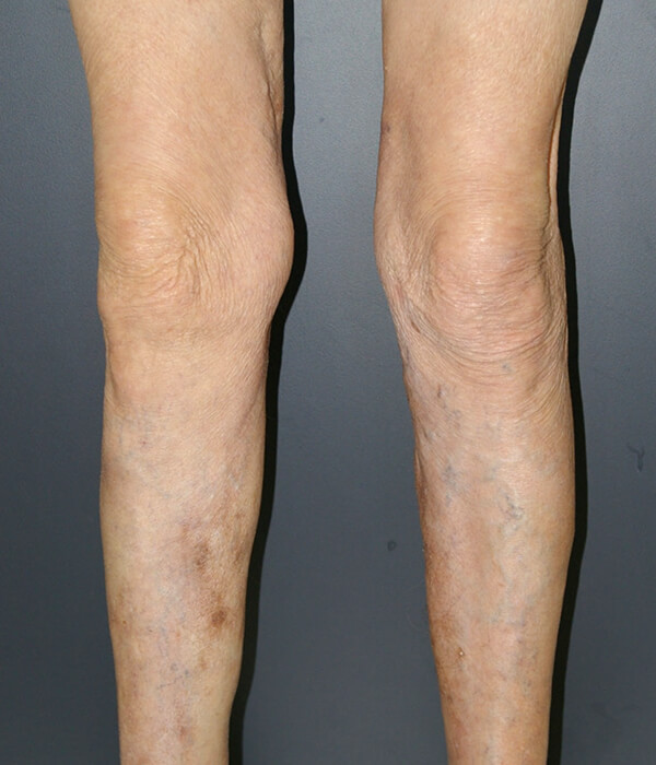 Varicose Vein Treatment Melbourne