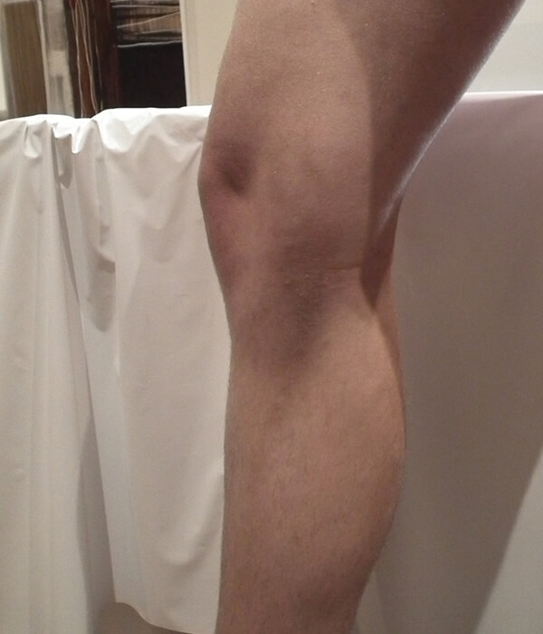 Legs showing untreated varicose veins