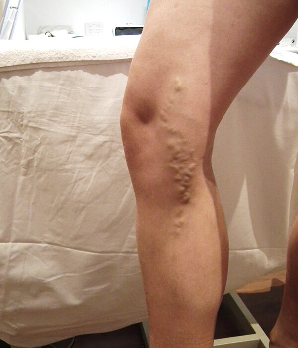 Legs showing treated varicose veins