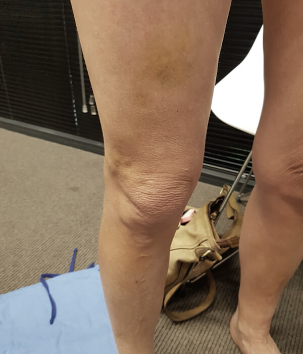 leg after endovenous laser ablation treatment