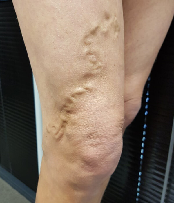 legs with large varicose vein