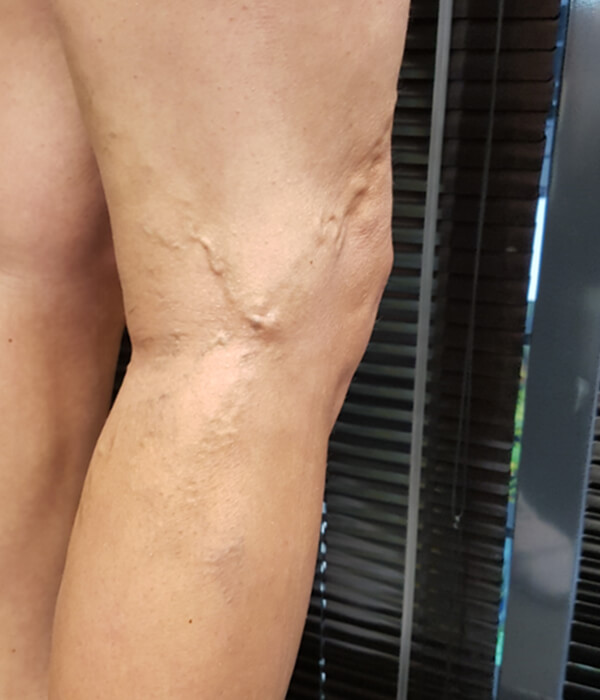 before sclerotherapy treatment for spider veins