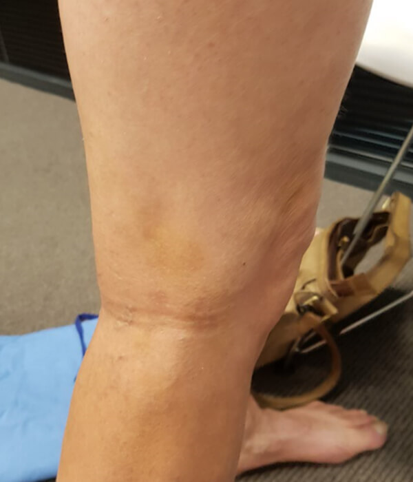 after sclerotherapy treatment for spider veins