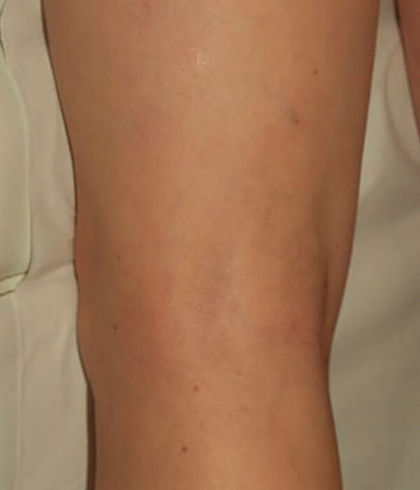 after sclerotherapy treatment for spider veins