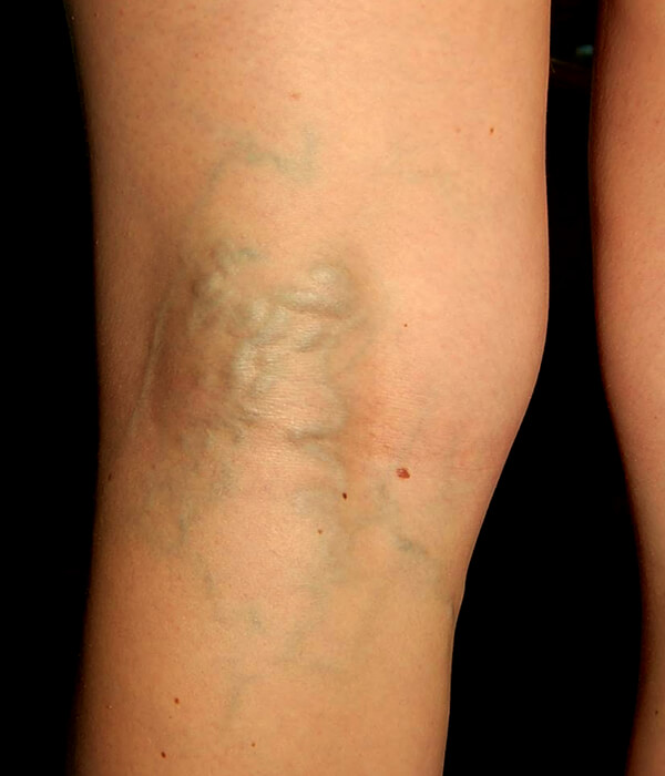 before sclerotherapy treatment for spider veins