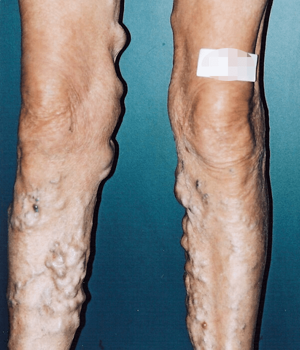 legs with advanced varicose veins before treatment