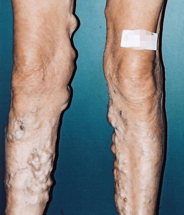 Varicose Vein Treatment Melbourne