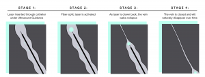 Endovenous laser ablation, varicose vein treatment, treatment infograph