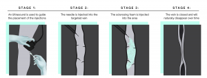 Ultrasound guided sclerotherapy, varicose vein treatment 