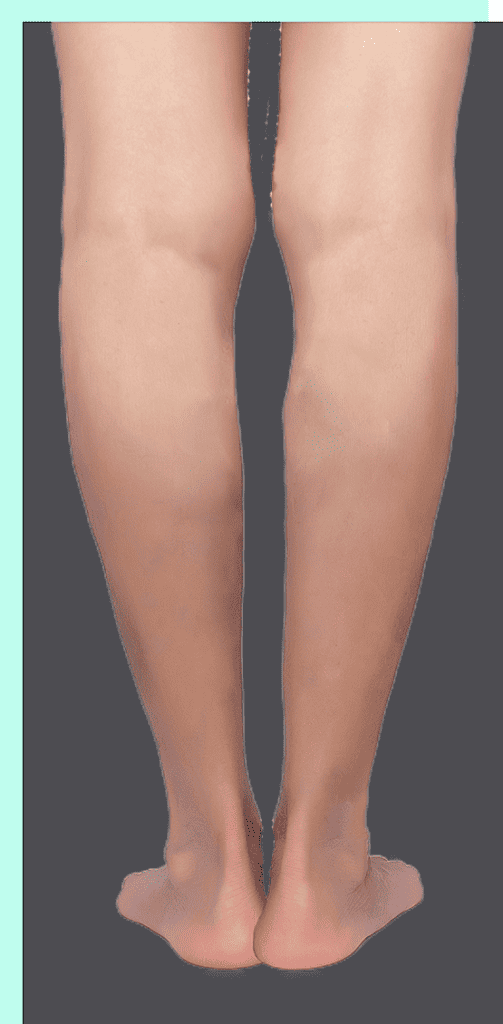 legs with no venous disease