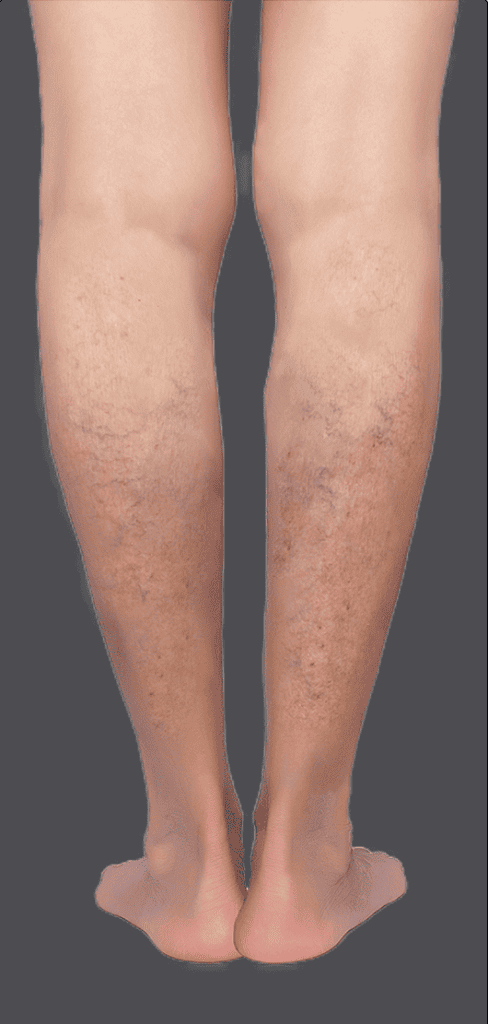 Legs with spider and reticular veins