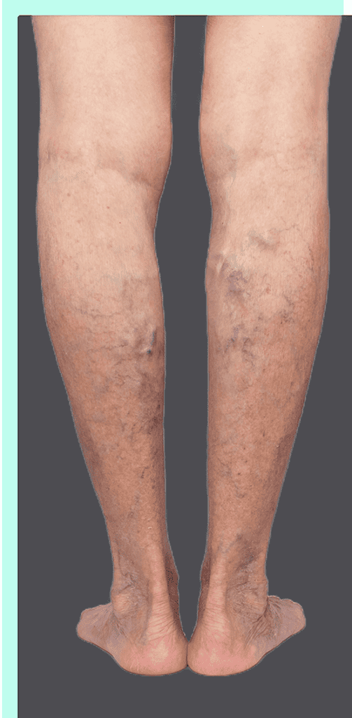legs with varicose veins and venous nodes
