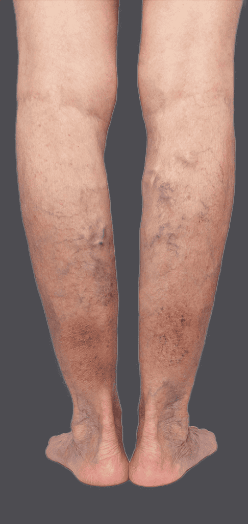 Legs with varicose veins and venous eczema