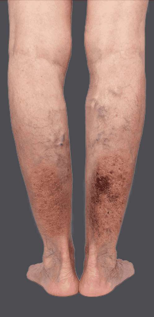 Legs with varicose veins and venous eczema