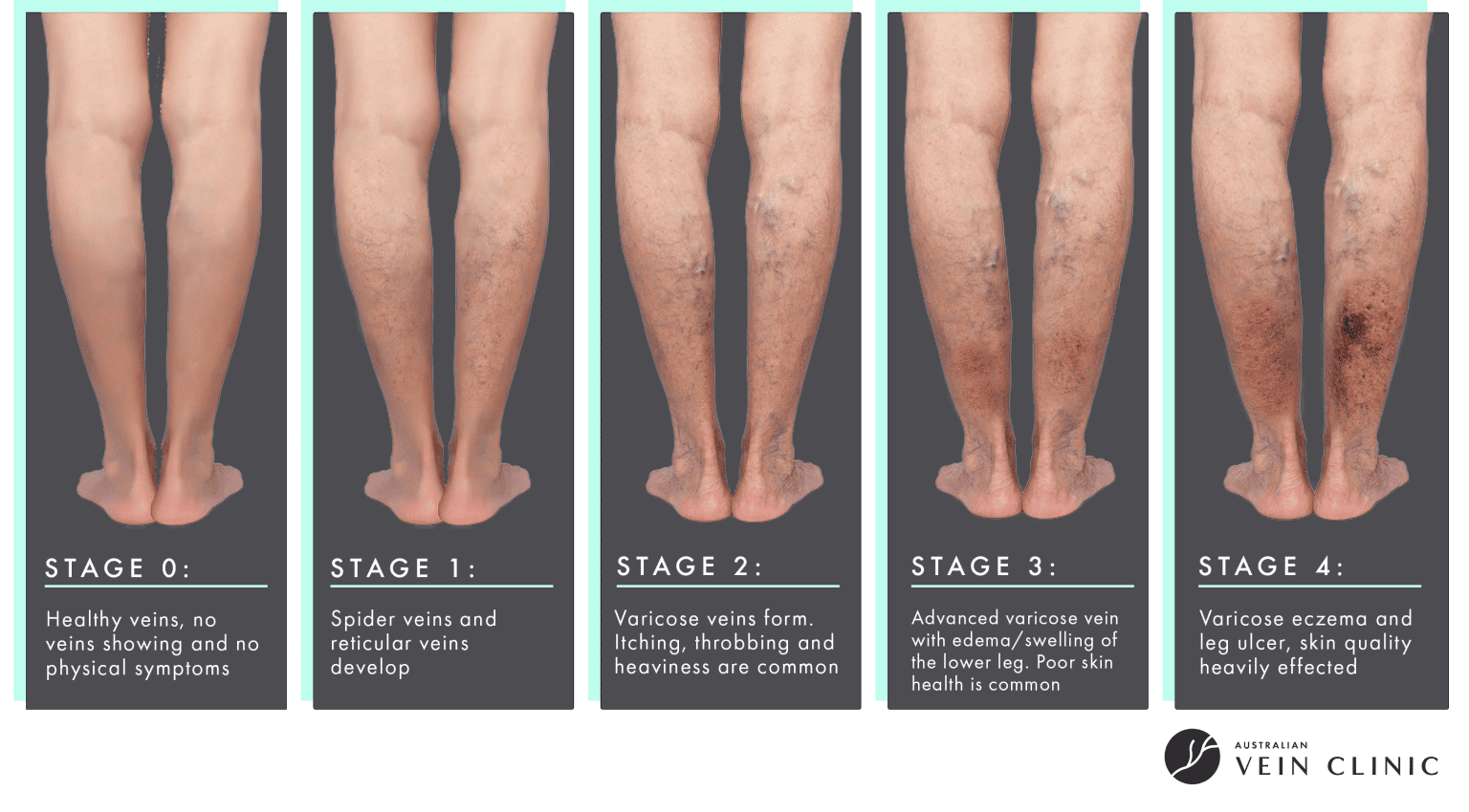 Ultrasound Guided Sclerotherapy | Varicose Vein Removal Melbourne