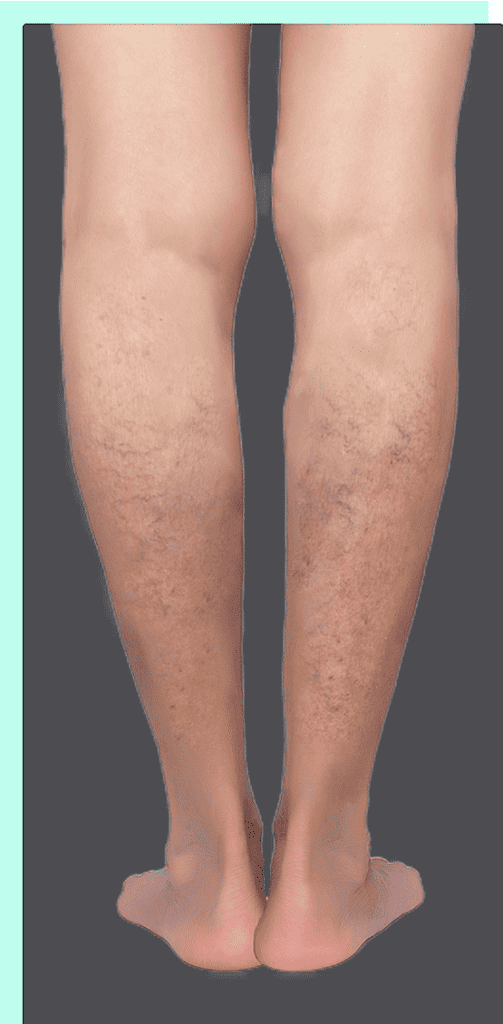 Legs with spider and reticular veins