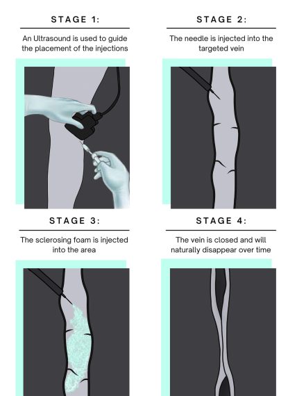 Infographic on Ultrasound Guided Sclerotherapy
