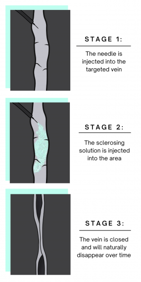 Infograph about how sclerotherapy works for treating spider veins